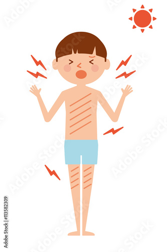 日焼け 炎症 子供 全身 イラスト Stock Illustration Adobe Stock