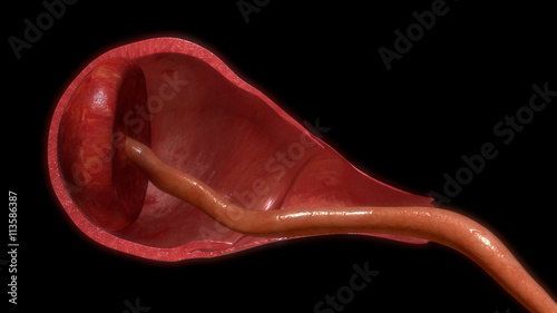 Tableau sur toile Pulling placenta out of uterus
