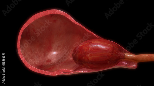 Foto Pulling placenta out of uterus