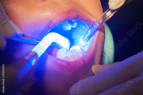 Dark, dental sealants for children aged 7 years.