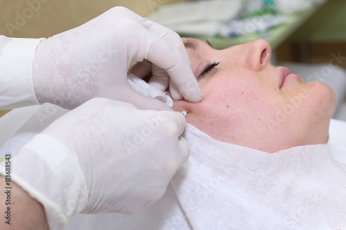 Procedure of face lifting surgery.