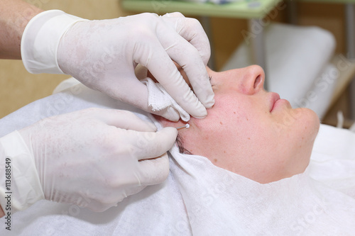 Procedure of face lifting surgery.