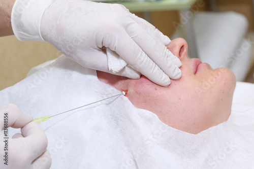 Procedure of face lifting surgery.