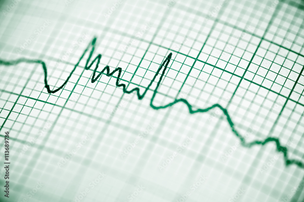 Electrocardiogram Electrocardiogram