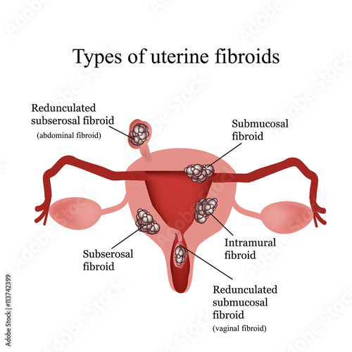 Types of uterine fibroids. Endometriosis. Infographics. illustration isolated on white background photo