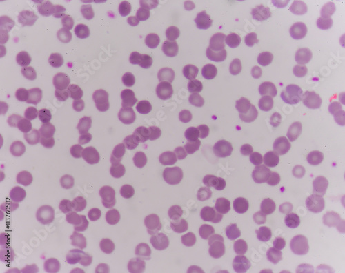 abnormal red blood cells