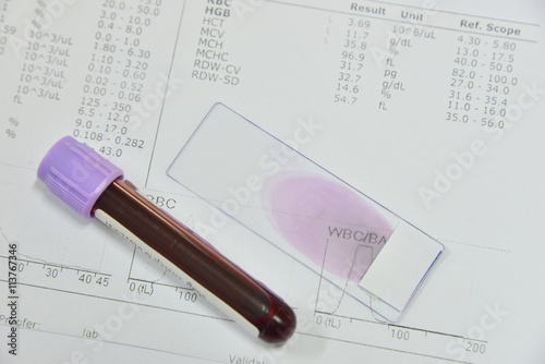 Canvastavla Blood test for Complete Blood Count. CBC