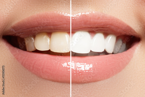 Perfect smile before and after bleaching. Dental care and whitening teeth
