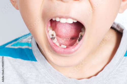 Young boy with mouth wide opened showing several tooth filling photo