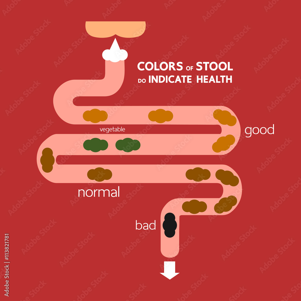 Infographic Of Excretory System Color Of Feces Do Indicate Health infographic-of-excretory-system-color-of-feces-do-indicate-health