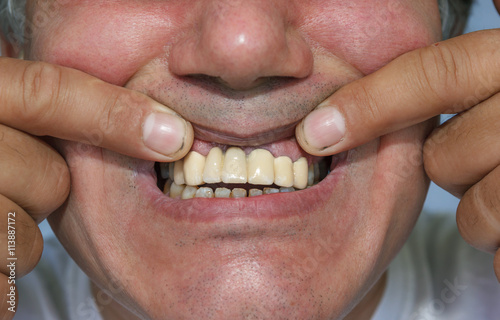 Canvas Print man showing false front upper teeth