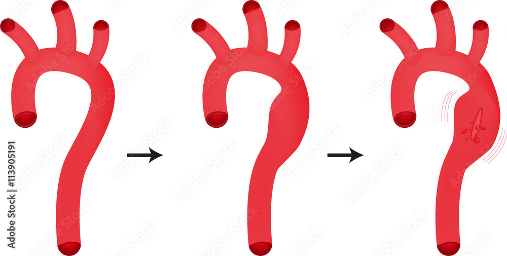 Aortic Aneurysm Stock Illustration | Adobe Stock