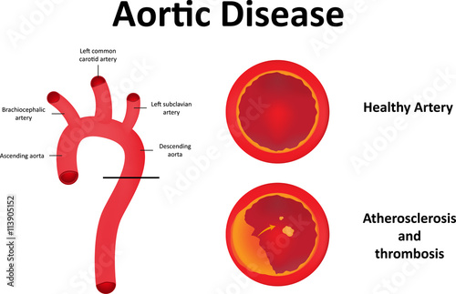 Aortic Disease Diagram