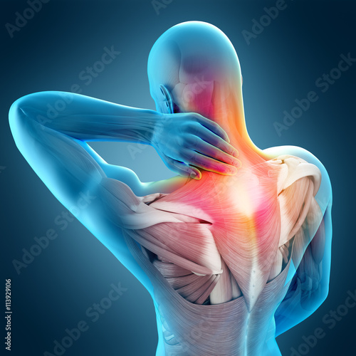 medically accurate 3d illustration of neck pain photo