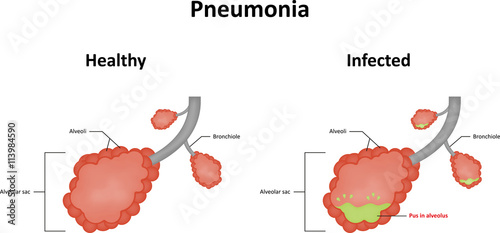 Fotografija Pneumonia Alveoli