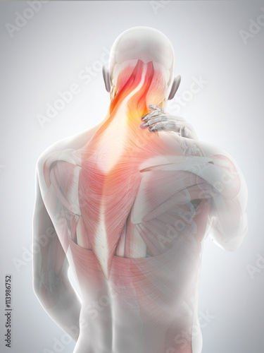 medically accurate 3d illustration of neck pain