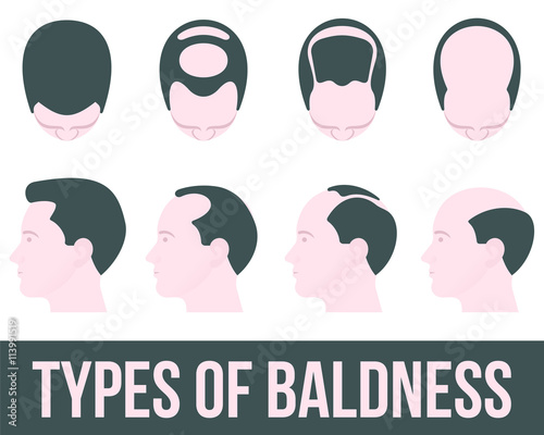 Stages of hair loss and hair treatment, vector illustration flat is isolated on a white background, different stages of hair loss, hair treatment and transplontatsiya color, health