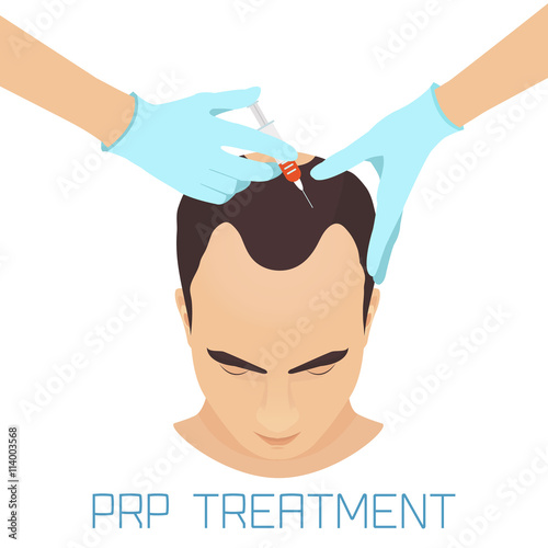 Platelet rich plasma injection procedure for men. PRP treatment process. Male hair loss treatment infographics. Meso therapy. Hair growth stimulation. Vector illustration.