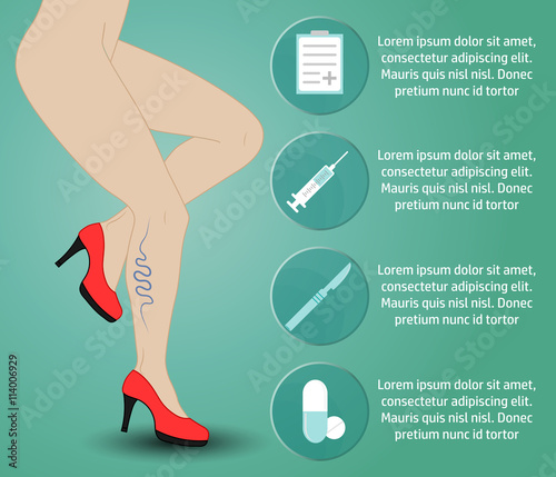 varicose_infographic