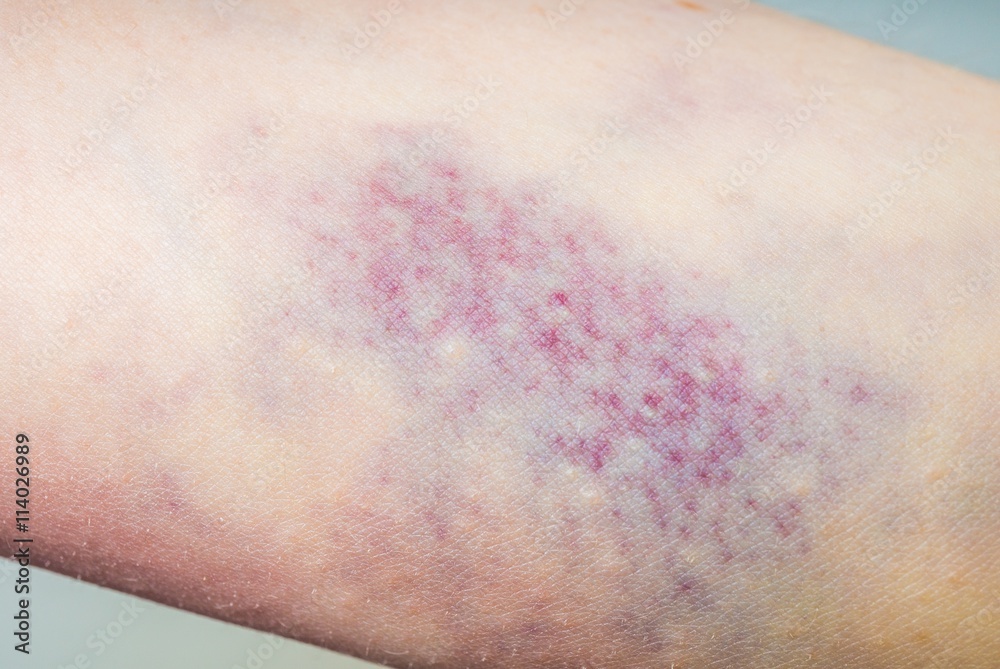 Macro shot of bruise on skin.