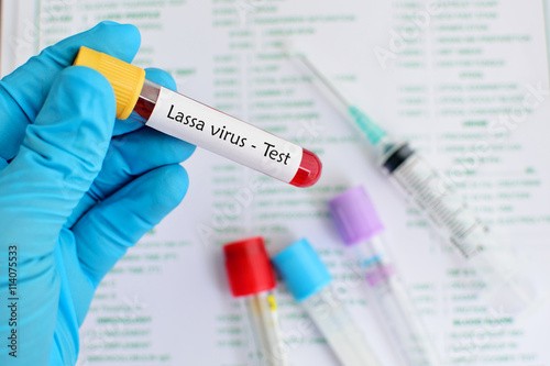 Blood sample for Lassa virus test, diagnosis for Lassa hemorrhagic fever
 photo