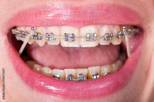 Closeup Ceramic and Metal Braces on Teeth with Elastic Rubber Ba