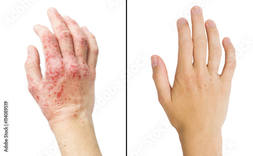 Real photo girl's hand, the patient with eczema before and after treatment