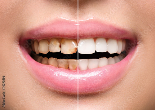 Photo Woman's teeth before and after whitening. Oral care