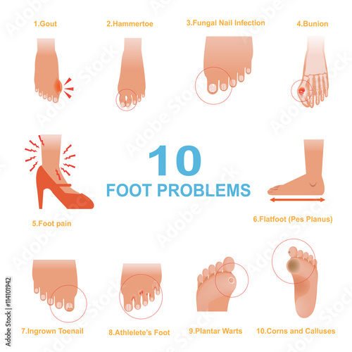 Foot Problems/Vector of Common Foot Problems