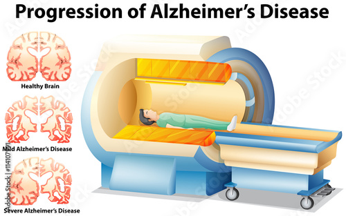 Progression of Alzheimer's Disease