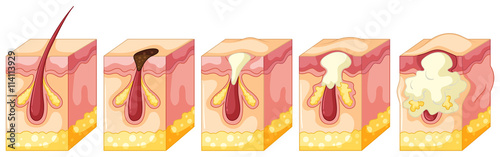 Diagram of pimple on human skin