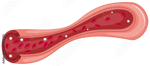 Close up diagram of blood clot