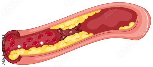 Close up picture of blood clot