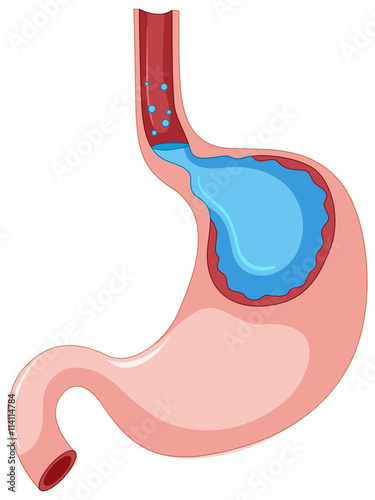 Gastroesophageal Reflux Disease stage