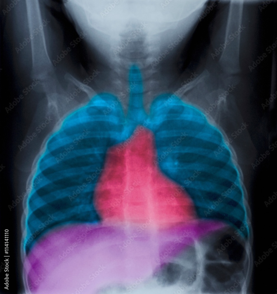 Normal chest X-ray of a 2 year old girl Stock Photo | Adobe Stock