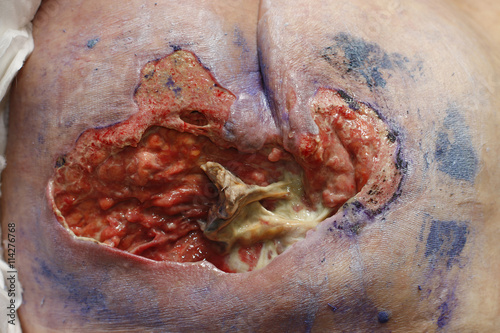 ulcer on the sacrum - bedsore II degree. Pressure Ulcers