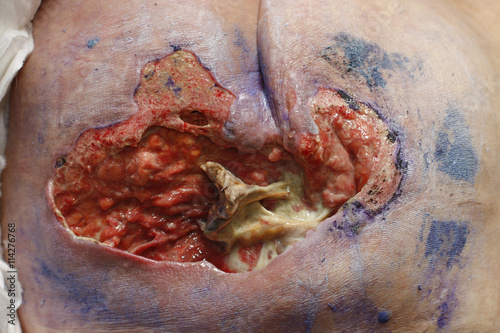ulcer on the sacrum - bedsore II degree. Pressure Ulcers photo