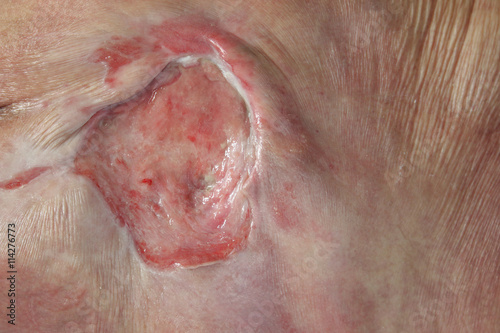 ulcer on the sacrum - bedsore II degree. Pressure Ulcers