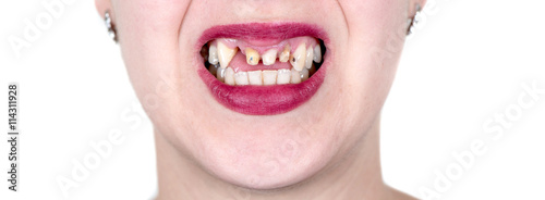 Smile of woman without front teeth photo