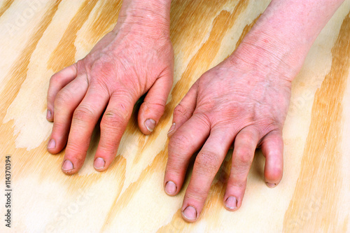 Rheumatoid arthritis