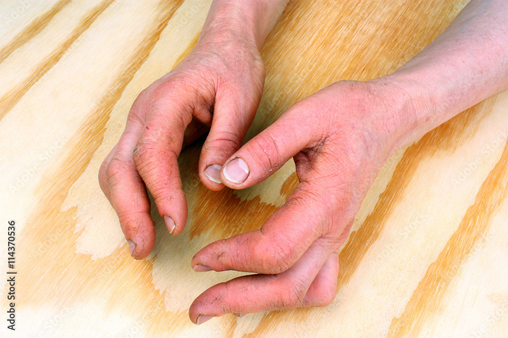 Arthritis of the hands Arthritis of the hands
