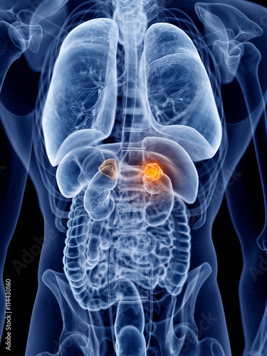 3d rendered, medically accurate illustration of adrenal gland cancer