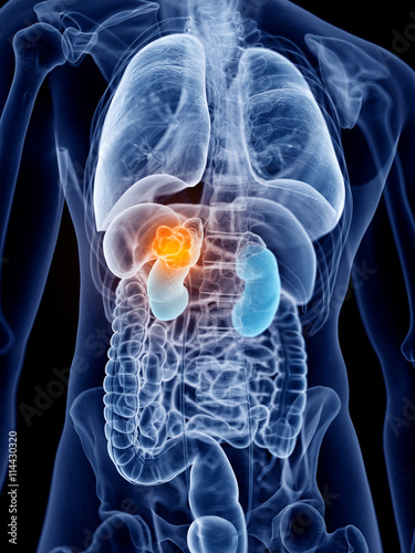3d rendered, medically accurate illustration of kidney cancer