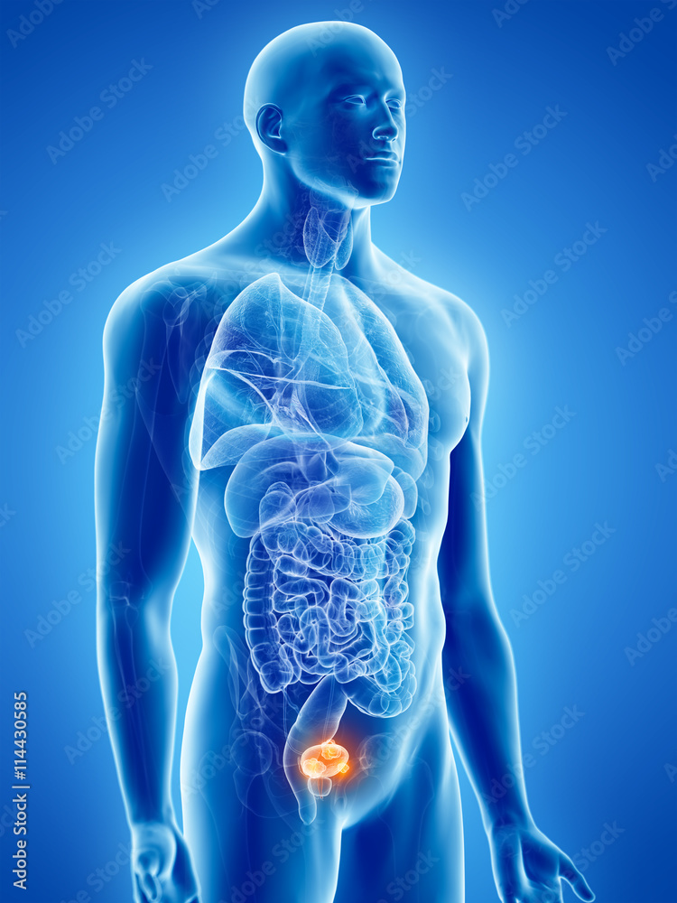 3d rendered, medically accurate illustration of bladder cancer 3d rendered, medically accurate illustration of bladder cancer