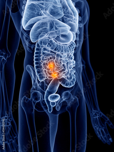 3d rendered, medically accurate illustration of intestinal cancer