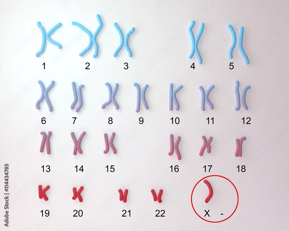 Turners Syndrome Karyotype Labeled X0 Karyotype 3d Illustration