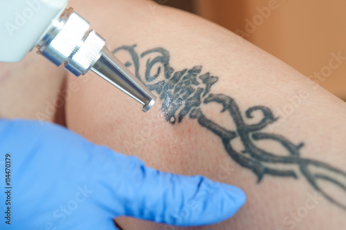 tattoo removal / laser tattoo removal from leg
