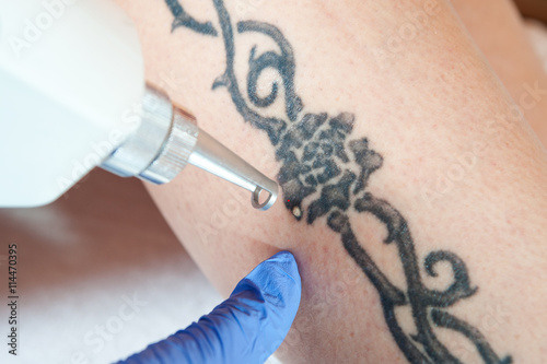 tattoo removal / laser tattoo removal from leg photo