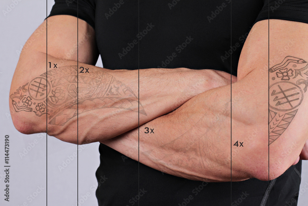 Laser tattoo removal before and after. Attractive Man with tattoo on his  hand skin Stock Photo | Adobe Stock