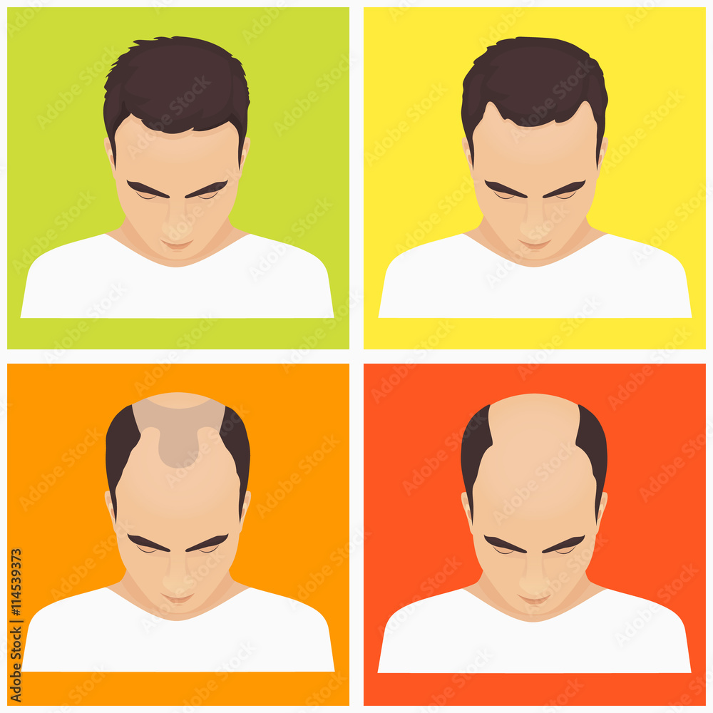 Male hair loss stages set on multicolored background. Male pattern  baldness. Different stages of hair loss in man. Transplantation of hair.  Human hair growth. Hair care concept. Vector illustration. Stock Vector |